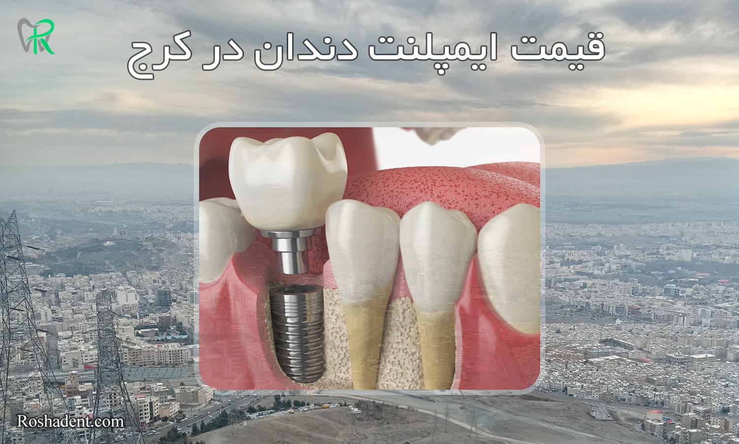 قیمت ایمپلنت دندان در کرج