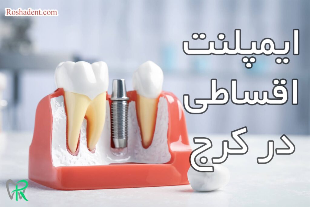 ایمپلنت دندان اقساطی در کرج