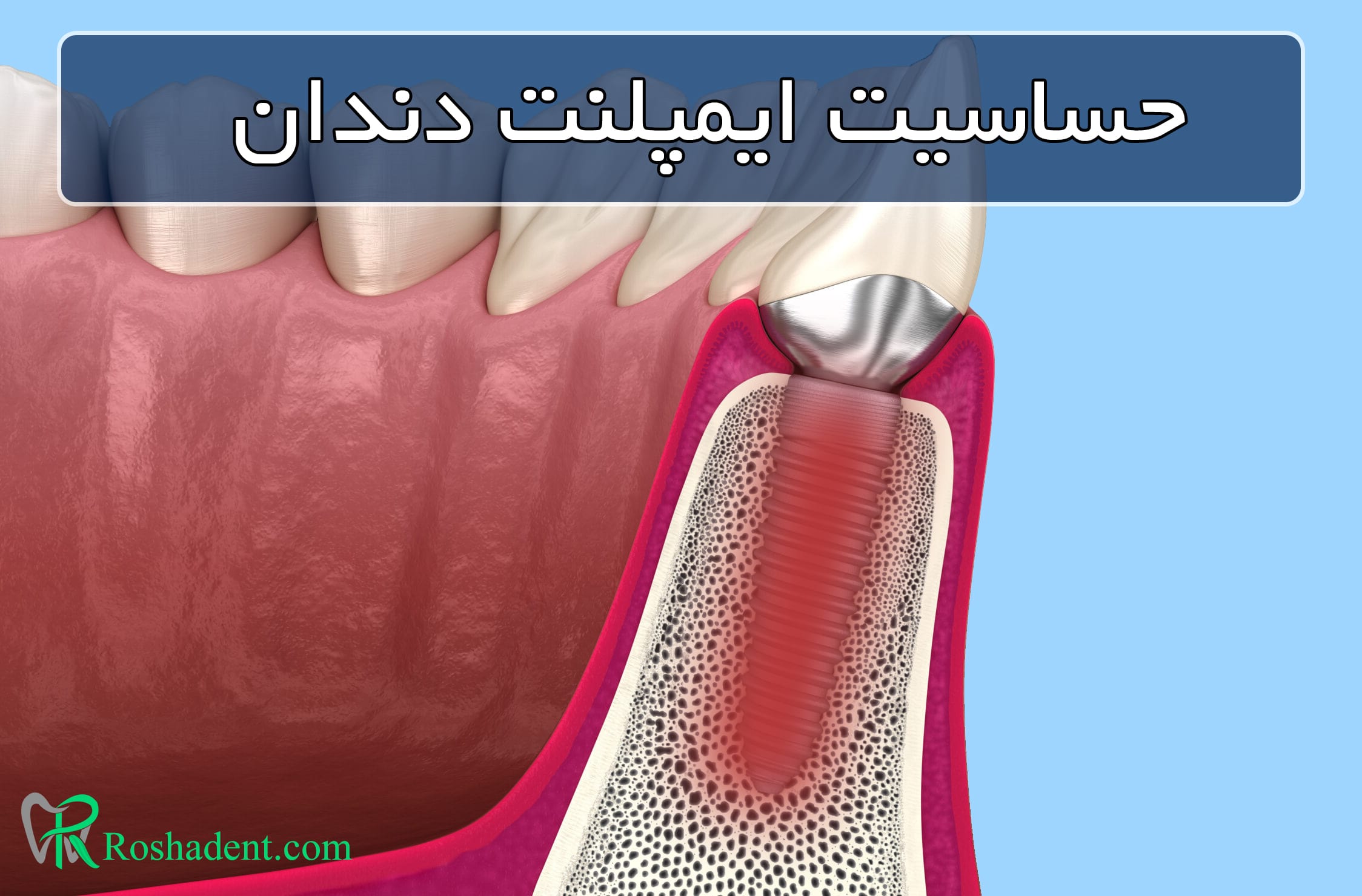 حساسیت ایمپلنت دندان
