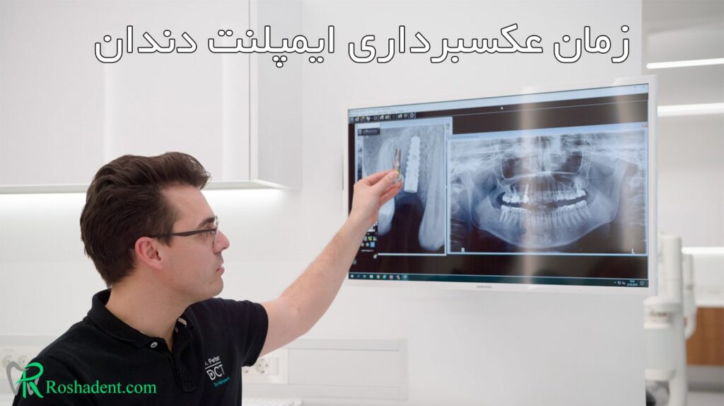 زمان عکسبرداری ایمپلنت دندان