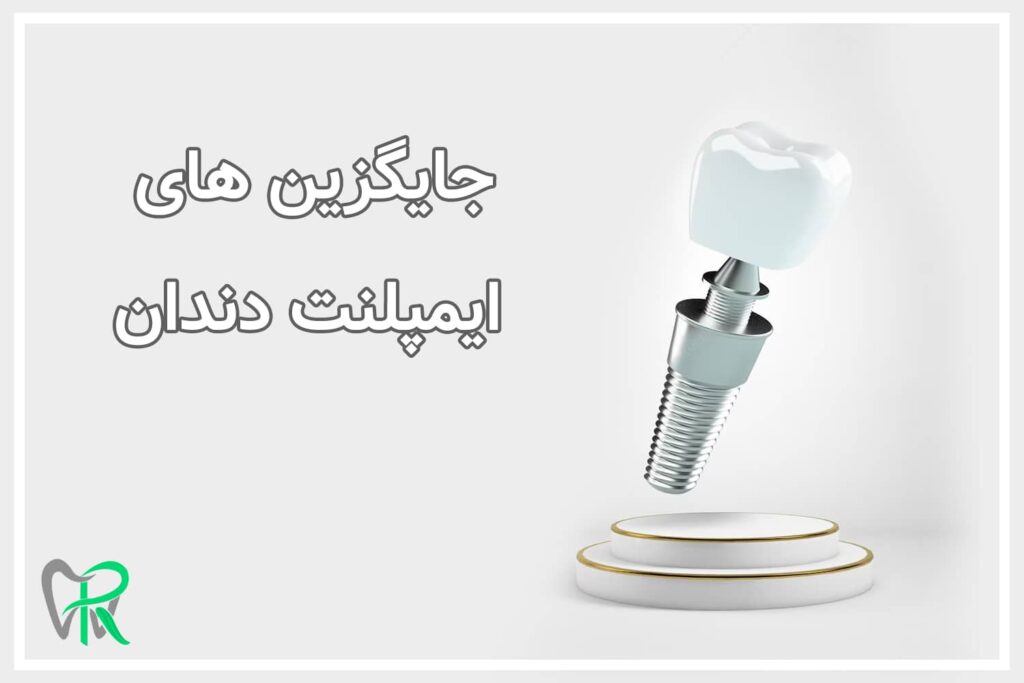 جایگزین های ایمپلنت دندان
