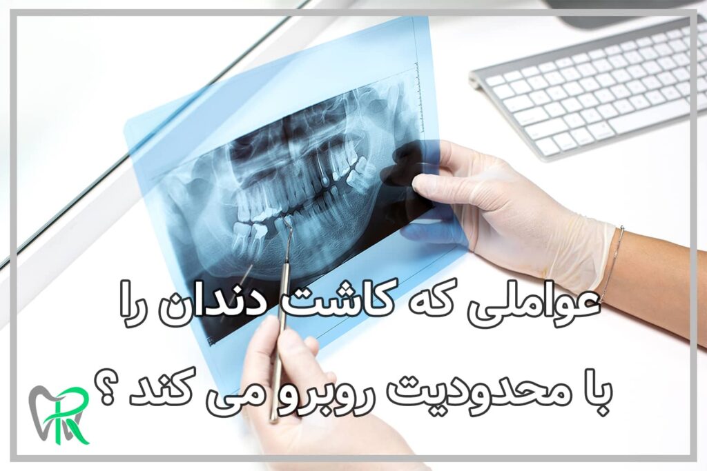عواملی که کاشت دندان را با محدودیت روبرو می کند