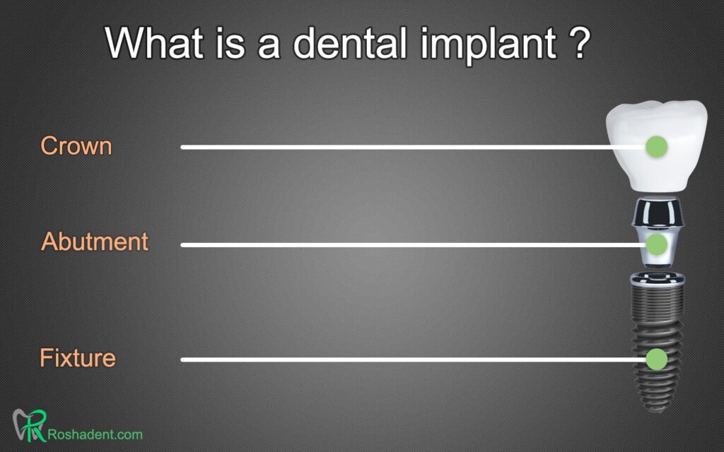What is a dental implant?