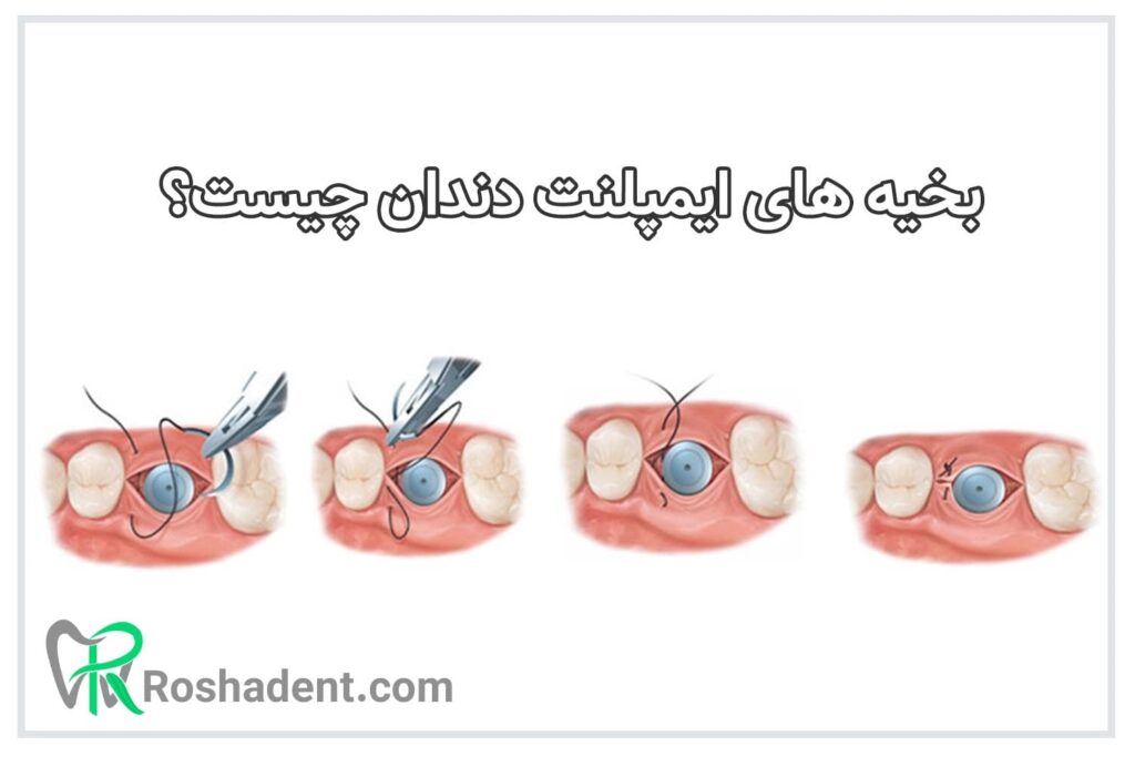 بخیه های ایمپلنت دندان چیست