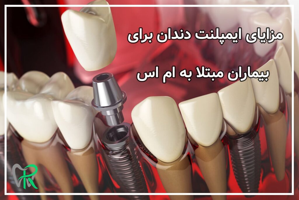 مزایای ایمپلنت دندان برای بیماران مبتلا به ام اس